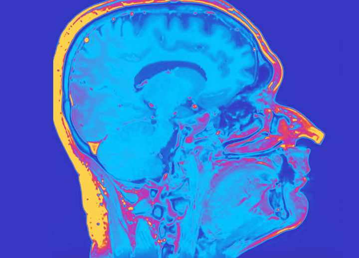 How ADHD Can be Exacerbated By Your Cycle, and Links to PMDD and Endometriosis