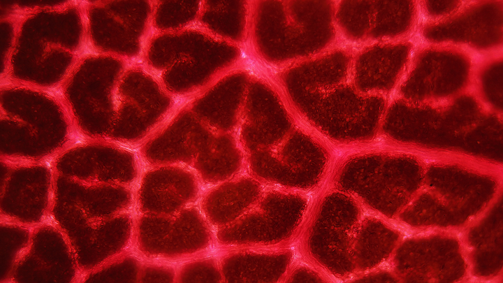 Endometriosis and The Prolactin Hormone