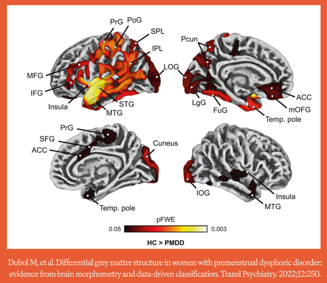PMDD is visible on brain scans
