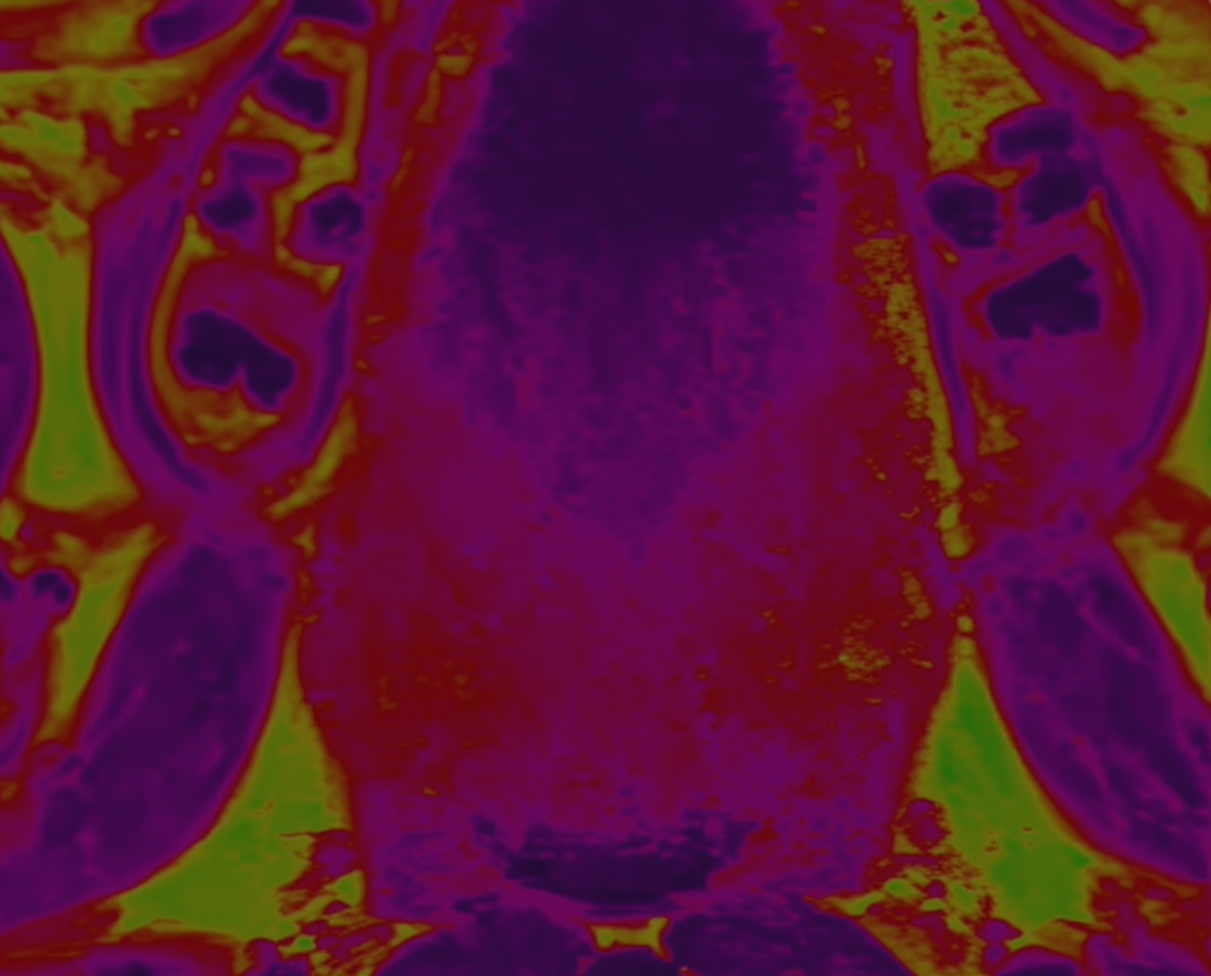 The Neurobiology Behind PMDD